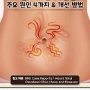 배꼽때 제거 염증 배꼽 위 아래 왼쪽 오른쪽 주변 통증 원인 치료 이미지