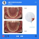 서울 가지런이 치과교정과 치과의원 | 단기간 앞니교정 잘하는 치과