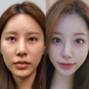 리프성형외과의원 | 20대~40대 내시경 이마거상 전후 후기
