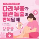 주성산 이진용맘병원 | 부산 하지정맥류 치료, 다리 부종과 혈관 돌출이 반복될 때