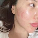 글래드성형외과의원 | 귀켈로이드제거수술 + 후처치 하러 간 김에 대구성형외과에서 대구인모드까지 해보림 (대구귀켈로이드...