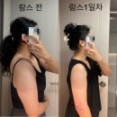 예쓰멍! | [부유방 팔뚝람스 1주차 솔직후기] 멍, 붓기, 통증🫢🫢