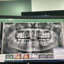 서경덕치과의원 | 신림역치과 매복 사랑니발치 후기