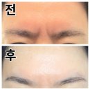 개팔자 상팔자 | 서면역 피부과 신상 제주에서 만든 국산보톡스 하이톡스 미간·팔자 주름보톡스 후기 이렇게나?!