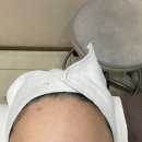 아비 | 영등포 피부과 여드름레이저 아비클리어 내돈내산 후기