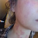 이연의원 | [혐오주의] 편평사마귀 제거 후 듀오덤 알레르기 극복기_비판텐, 에스로반, 베리큐어, 네오덱스