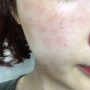 청담포유의원 | [부산기미레이저] 청담포유 피부과 의원 후기