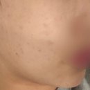 카프리 | 연신내피부과 카프리레이저 여드름치료 후기 (카프리레이저 주기 및 효과 정리)
