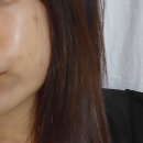 여수연합치과의원 | 여수서울연합의원에서 잡티 제거한 후기 (매우 간단)