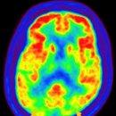 비정형 파킨슨 증후군Atypical Parkinsonism뇌신경정신질환 이미지
