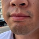 밴스의원춘천 | 남자 턱수염 레이저 제모 후기 춘천 밴스의원
