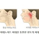 편도선 부었을때 편도 아데노이드 비대증 수술해야할까 이미지