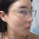 이마 | 부산 서면 피부과 이마필러 솔직후기 !!