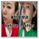 리투필라테스 | 동탄역 피부과 리투오5cc 랑 물톡스 받고 온 내돈내산 찐 후기 피부 분석부터 7일간의 변화 리뷰 해볼게요