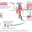 말라리아 말라리아 증상 말라리아 잠복기 발생시기 말라리아 감염증상 치료 이미지