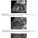 비뇨의학과 외래 진료실에서 놓치지 말아야 할 신장 초음파의 정상 소견 이미지