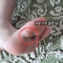 광장약국 | 초4 어린이 티눈이 아니라네ㅠ 발가락염증