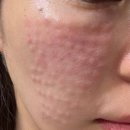 멍크루 | 노원 쁨클리닉 스킨부스터 필로드 3차 후기