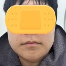 브이핏 | 일산 피부과 브이에스라인의원, 온다리프팅 브이핏 주사 솔직 후기