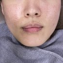 코끼리한의원 | 신논현한의원 • 더마샤인 스킨부스터 미주란(미주안) 후기 (통증, 다운타임 X)