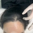 5809 | 논현두피문신 탈모커버 전문 살롱드예노 헤어라인+정수리 시술후기