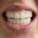 바른정플란트치과의원 | 칫솔질이 먼저일까, 치실이 먼저일까? (달서구 치과 잘하는 곳 )