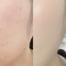 에스와이바른피부과의원 | 마곡 피부과 피코토닝 엑셀브이레이저 가격 잡티제거 솔직후기