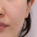 논현빌딩 | 강남 신논현 세르프 리프팅 후기, 마취 없는 안 아픈 팔자주름 관리