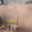✨ [라미에스테틱 여드름문제성피부,트러블 케어전문+ 스킨플래닝 관리 후기]