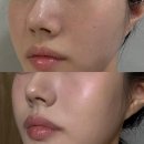 Point-붉은 날 | 부산화명동피부과 쥬베룩스킨 모공레이저 받아본 솔직후기