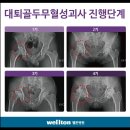 고관절인공관절, 고관절통증 - 인공관절수술잘하는곳 , 고관절 인공관절치환술 후 바로 걷기가능 이미지