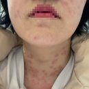 이화미의원 | [이천] 여자들만 아는 불편한 편평사마귀&amp;쥐젖제거 이화미의원 후기