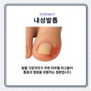 성남시 태평동 내성발톱 치료 방법 선택 전 알아둘 부분
