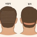 모제림외과의원 | [모제림 성형외과]모발이식,헤어라인 모발이식상담후기