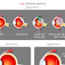 망막박리 증상 &amp; 원인 안구 타박상 응급처치, 수술 이미지