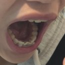 포이연치과의원 | [수원서울바른치과 교정후기] 바이트블럭, 잇몸염증, 미니스크류 등등 힘들었던 1년 8개월동안 교정...