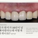 앞니 오래된 PFM을 한지 오래되어서 까맣게 되었어요. 앞니치료전문 미플러스치과 후기입니다. 강추예요^^