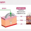네오성형외과의원 네이버블로그