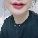 지금처럼 | 턱필러 입술필러후기 대만족 정리