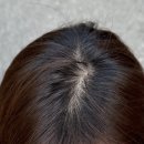 에이에이쥐올에프터글로우 - 중구 중앙길 171-1 | 머리카락 심지 않고 채우기… 두피문신 3회 후기 | 은평구 드로플릿 SMP