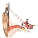 와우복지용구 | 밀양보청기 밀양서울보청기 난청 치료를 위한 보청기, 인공와우 차이점은?