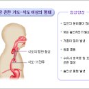 선천성 식도폐쇄 이미지