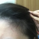 동성온누리약국 | [공지] [리얼후기] 여성 미녹시딜 3% - 휑했던 가르마가 4개월 만에 빽빽해진 비결 (사진 인증)