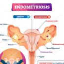 생리통심한이유 자궁내막증 초기일 수도 있습니다. 이미지