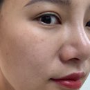 부평자동차병원 | 기미부자, 부평 기미잡티 피부과 레이저 2회차 치료 효과 리얼후기 남겨요