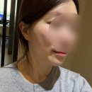 필러 | 강남역피부과 옆볼꺼짐 필러 내돈내산 후기 (가격, 사진有)