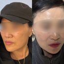 대전피부과 슈링크유니버스후기