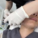 더노블강남삼성성형외과의원 | 삼성역피부과 티타늄리프팅 60kj + 턱라인 스킨보톡스 후기