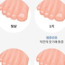 내성발톱 증상 원인 치료 이미지