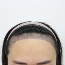 3295 | [대다모 포토후기] 20대 여성 3295모 모발이식 14일 후기입니다.